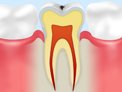 エナメル質の虫歯【C1】