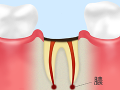 末期の虫歯【C4】