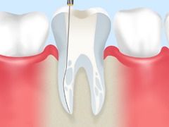 根管治療について