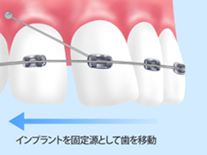 ミニインプラント矯正