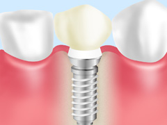 インプラント